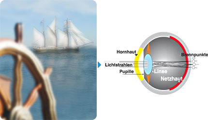 Hornhautverkrümmung | Vergleich von Fehlsichtigkeiten / Augenoperation, LASIK