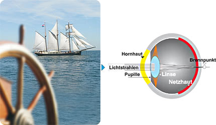 Weitsichtigkeit | Vergleich von Fehlsichtigkeiten / Augenoperation, LASIK
