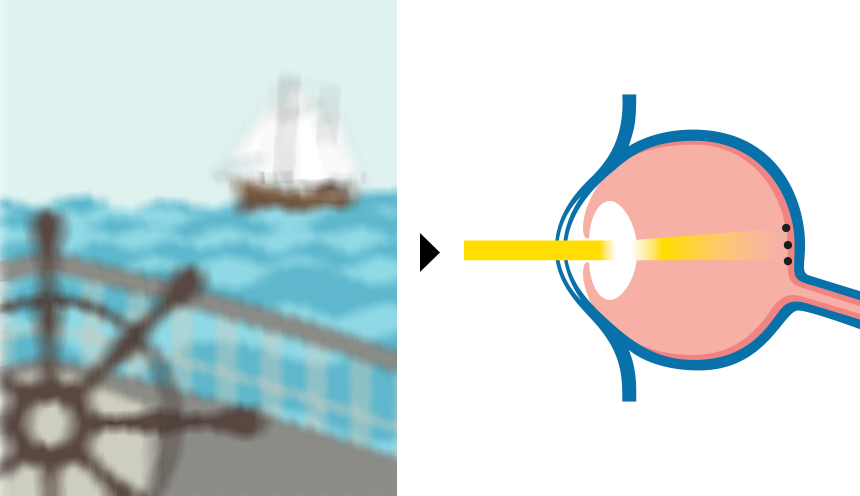 Hornhautverkrümmung | Vergleich von Fehlsichtigkeiten / Augenoperation, LASIK