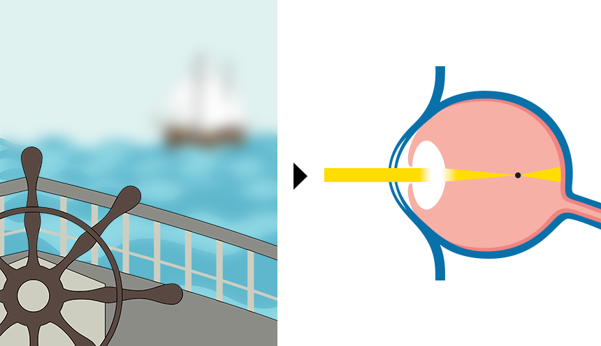 Kurzsichtigkeit | Vergleich von Fehlsichtigkeiten / Augenoperation, LASIK